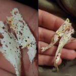 This insect doesn’t bite or sting — but it can burn your skin badly if you crush it